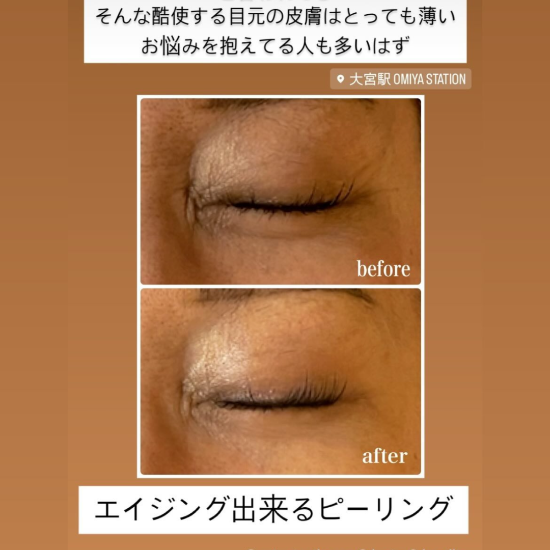 Lami Peel – Korean Beauty Academy